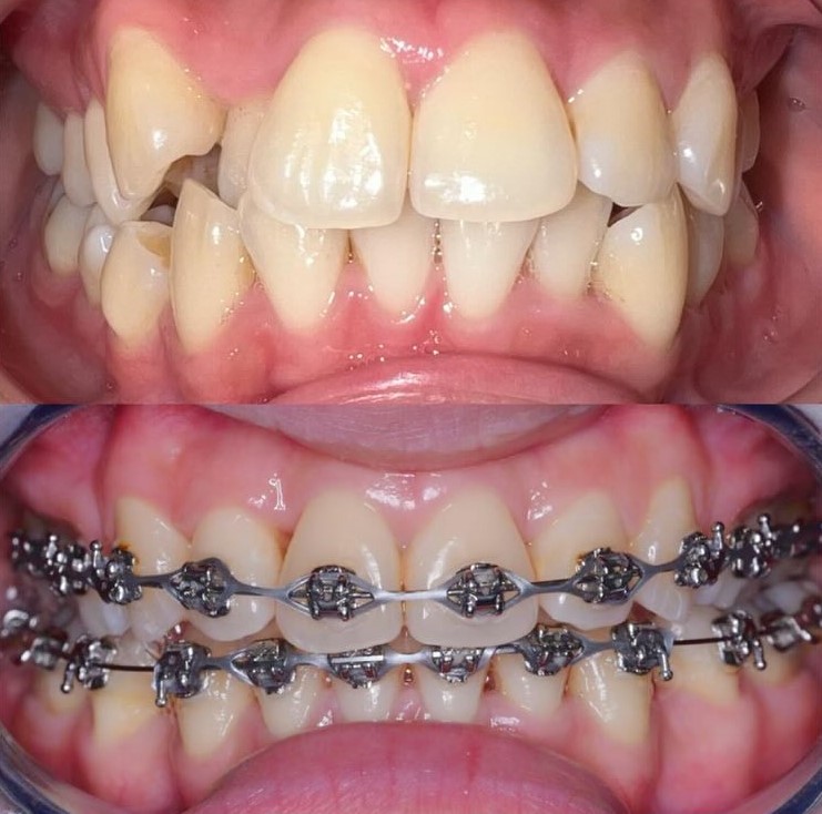 braces-treatment-before-and-after