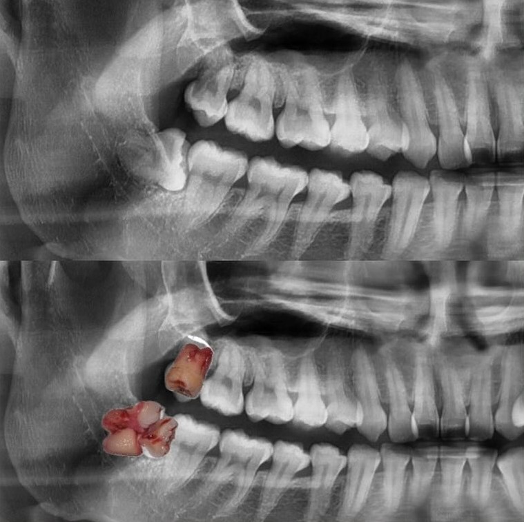 wisdom-tooth-before-and-after