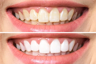 teeth-whitening-before-and after