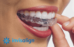 closeup-photo-of-teeth-with-invisalign-clear-aligner-from-dental-space-cheras-certified-provider