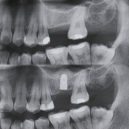 dental-implant-before-and-after