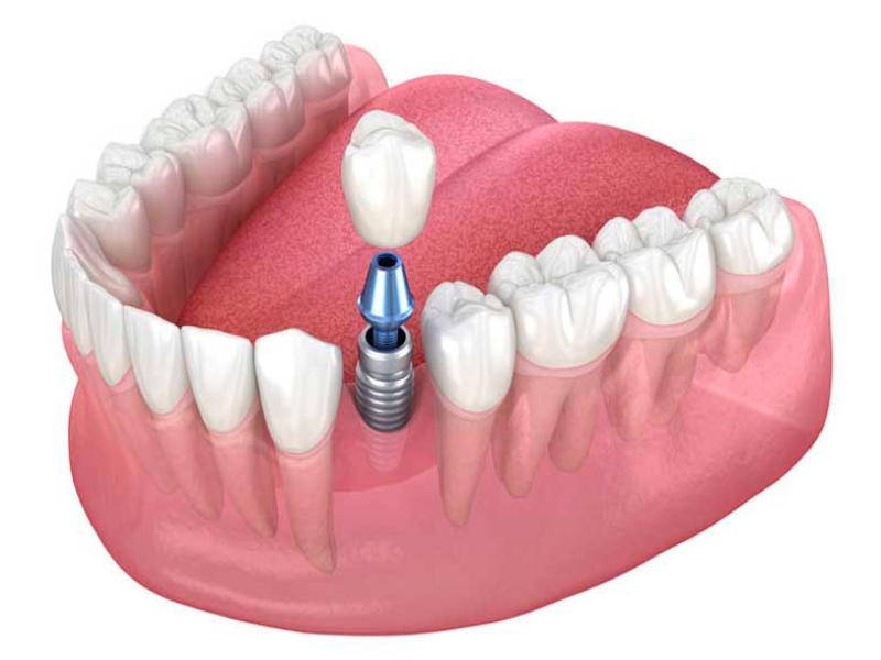 dental-implant