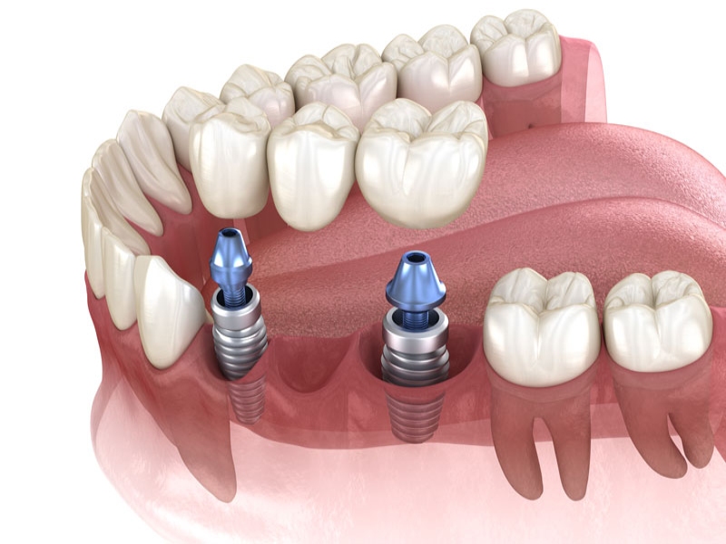 dental-implant