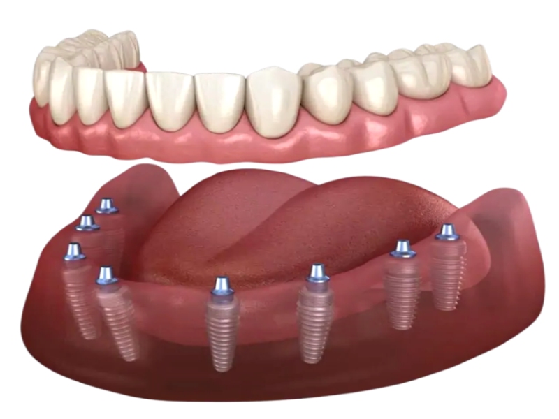 dental-implant