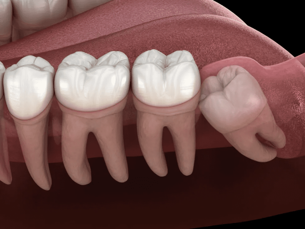 wisdom-tooth-removal-services-at-dental-space-cheras