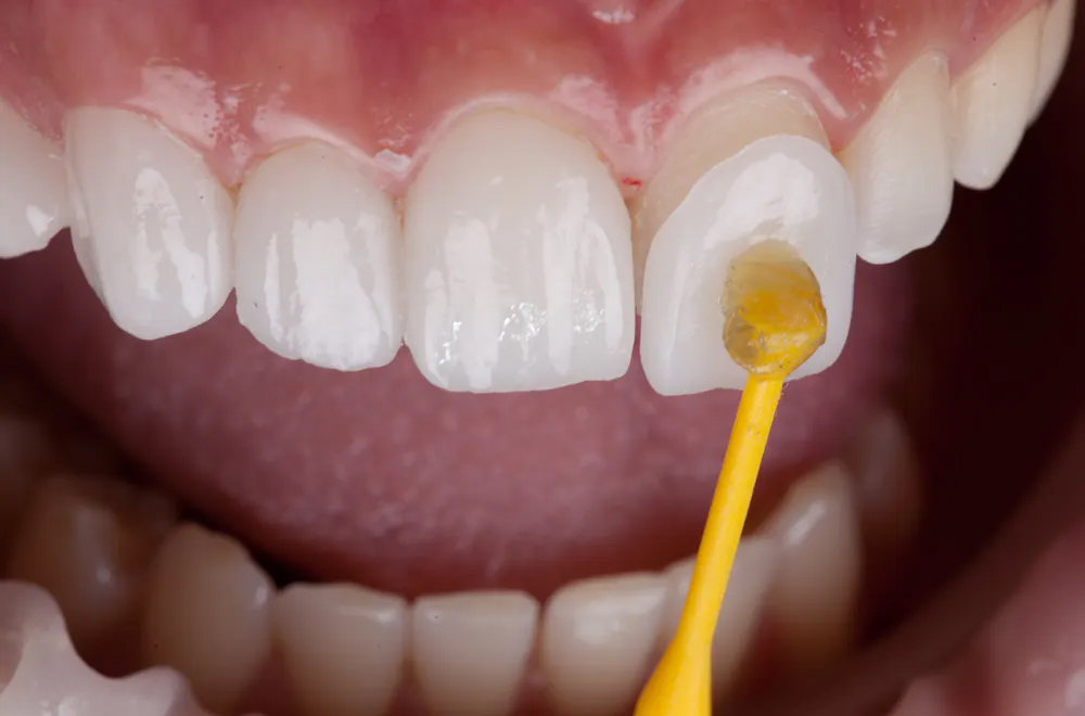 veneer-dental-service-closeup